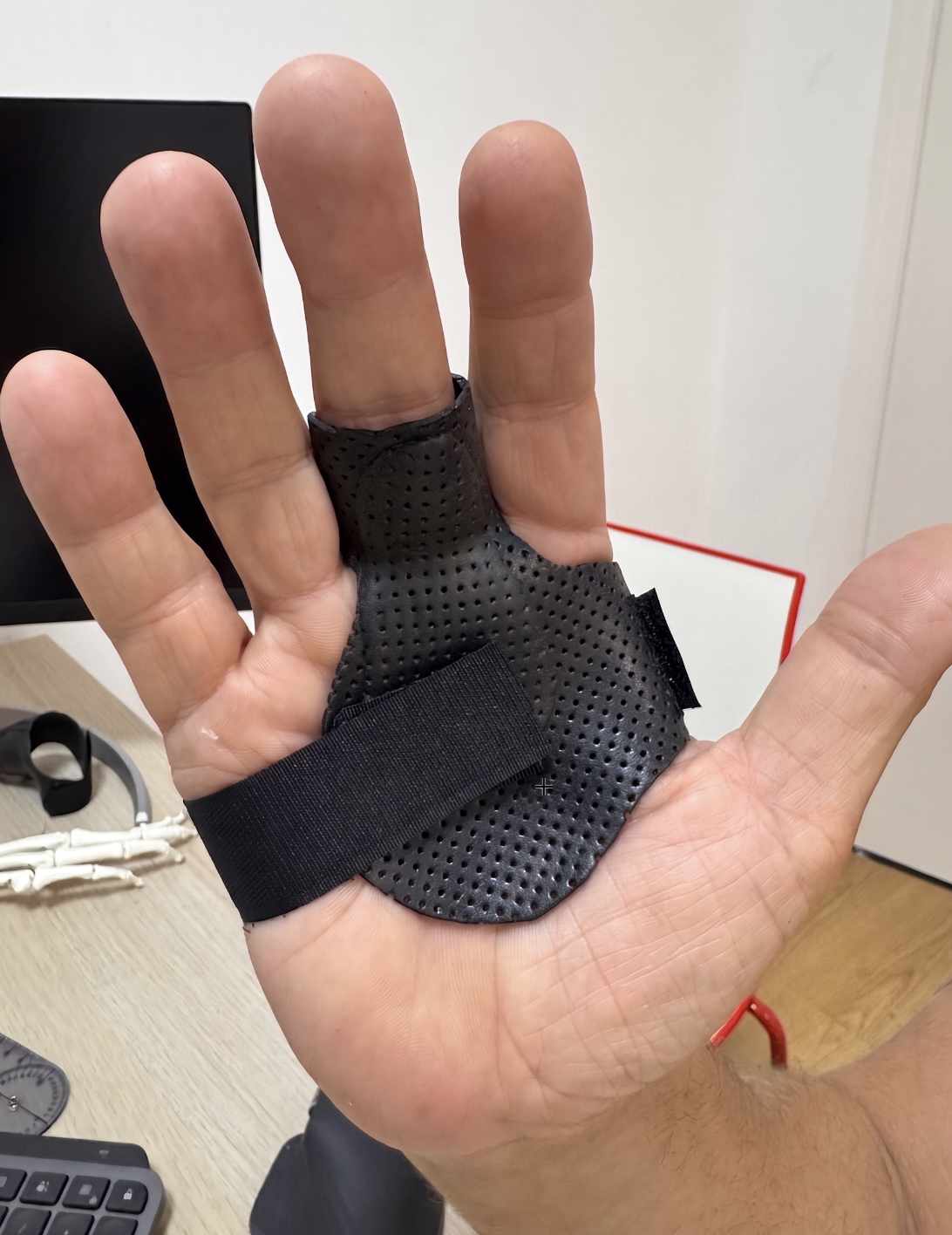 Op maat gemaakte spalk voor een trigger finger, gedragen op de hand